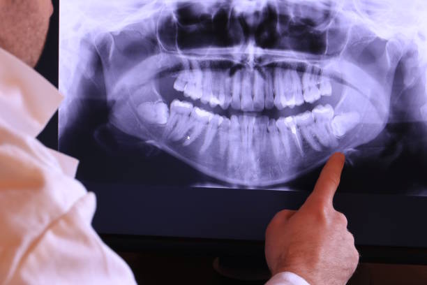 Best Emergency Wisdom Tooth Extraction in Linden, TX